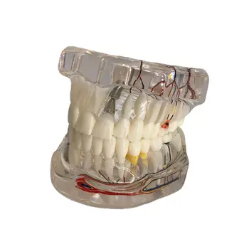 Модель зубных имплантатов G5AA с Реставрационным мостовидным протезом для стоматолога Med